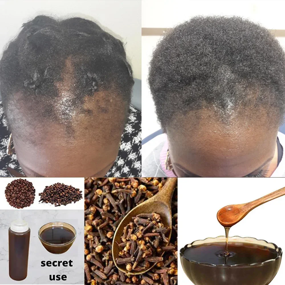 Africa Women Traction Alopecia - Hair Care Ginseng avaliação e preço