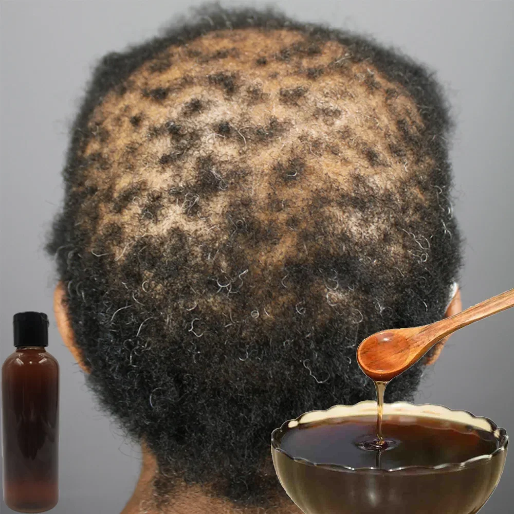 Africa Women Traction Alopecia - Hair Care Ginseng avaliação e preço
